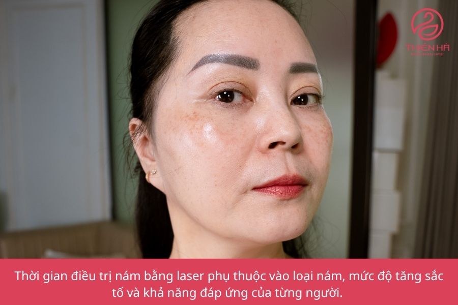 Các câu hỏi thường gặp về phương pháp laser trị nám