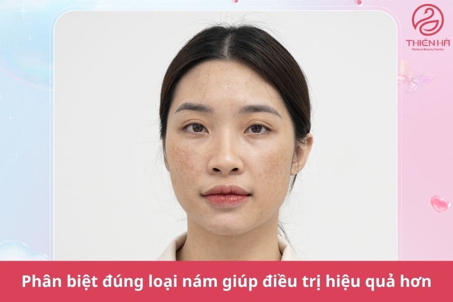 Xác định đúng loại nám là bước quan trọng trong điều trị