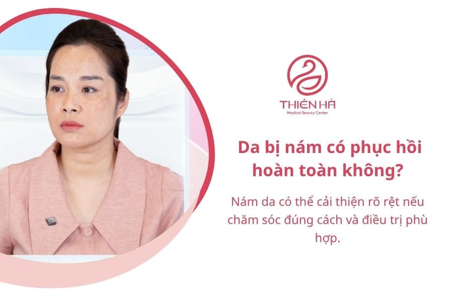Câu hỏi thường gặp về da bị nám 