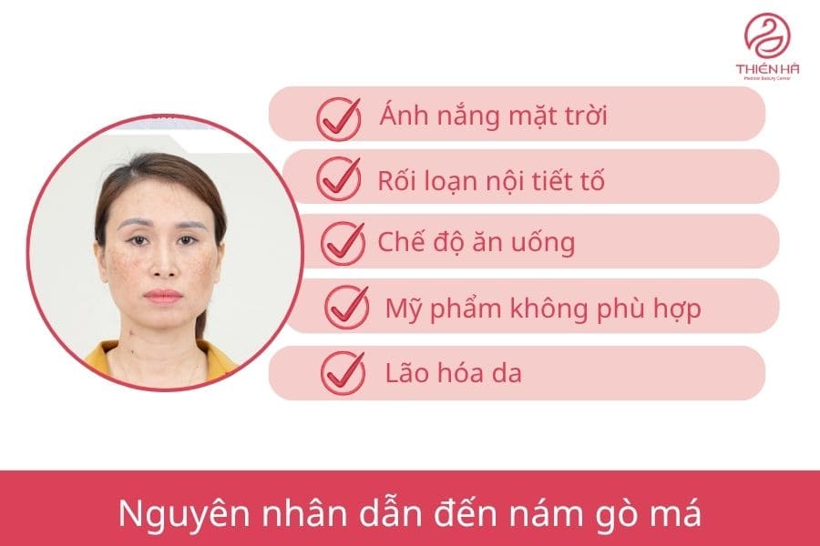 Top 5 cách trị nám gò má tại nhà hiệu quả dễ thực hiện 1 Nguyên nhân hình thành nám gò má