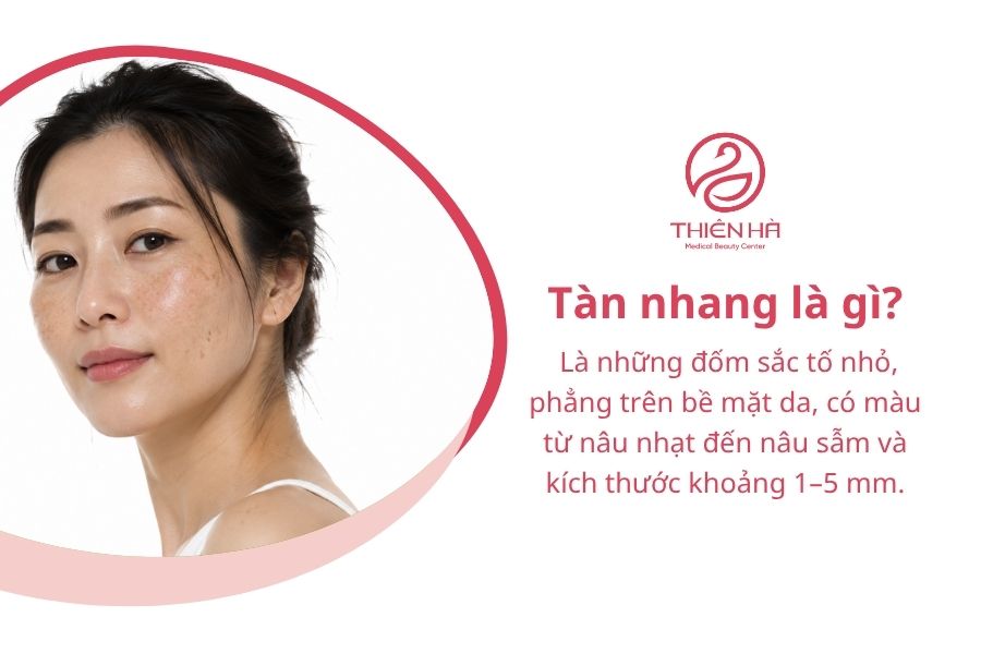 Tàn nhang là gì?