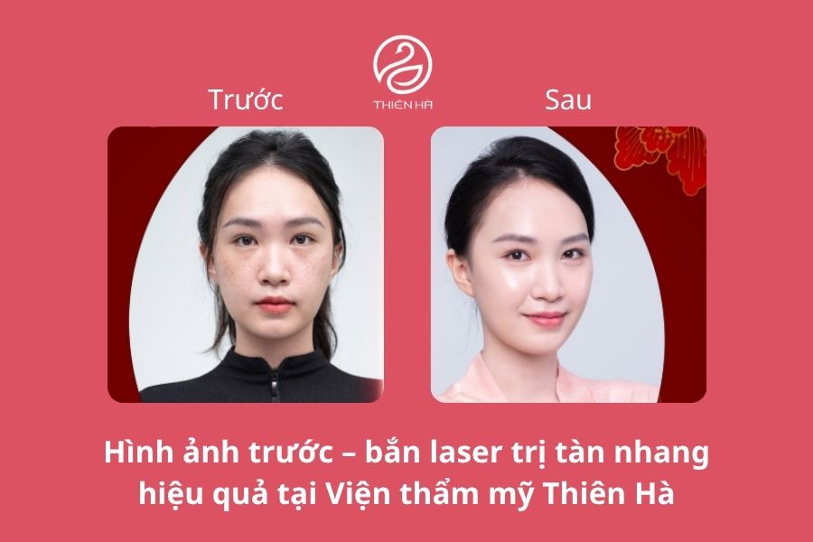 Viện thẩm mỹ Thiên Hà - Địa chỉ bắn laser trị tàn nhang hiệu quả 