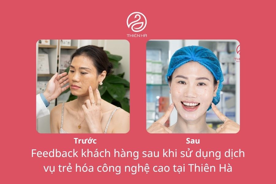 Top 5 Công nghệ trẻ hóa da dẫn đầu xu hướng ngành thẩm mỹ 10 Hình ảnh thực tế của khách hàng trước và sau khi trải nghiệm công nghệ trẻ hóa da tại Thiên Hà