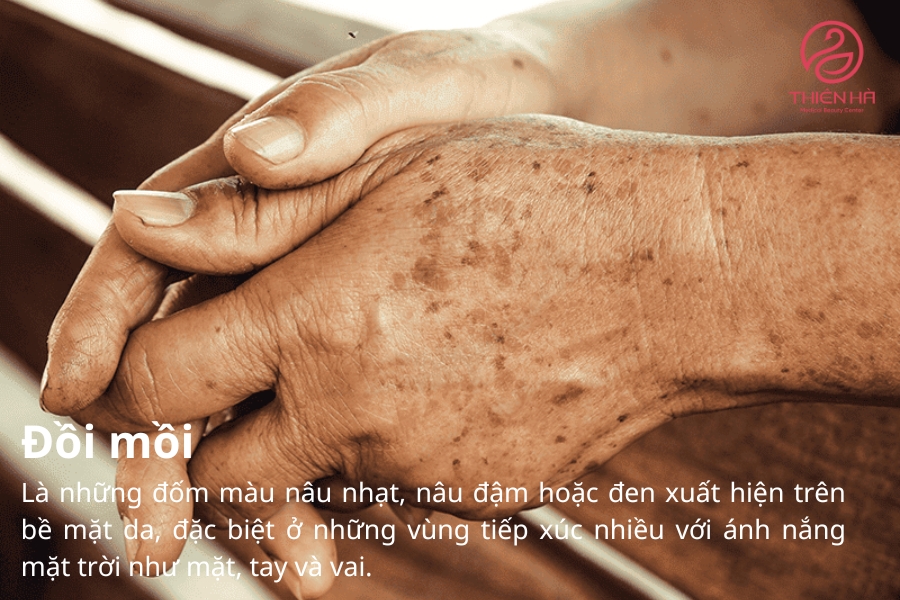 Đồi mồi xuất hiện nhiều ở người cao tuổi do lúc này sức “đề kháng” của da đã suy yếu và tạo điều kiện cho các hắc sắc tố tấn công