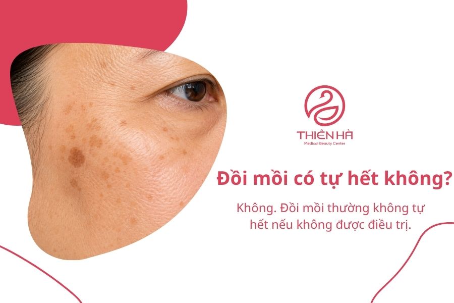 Đồi mồi là gì? Có nguy hiểm không và cách xử lý hiệu quả 5 Đồi mồi có tự hết không?