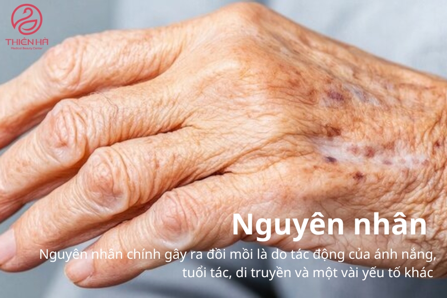 Việc hiểu rõ nguyên nhân giúp bạn có những biện pháp phòng ngừa và điều trị đồi mồi hiệu quả hơn, đảm bảo làn da luôn khỏe mạnh và đều màu.