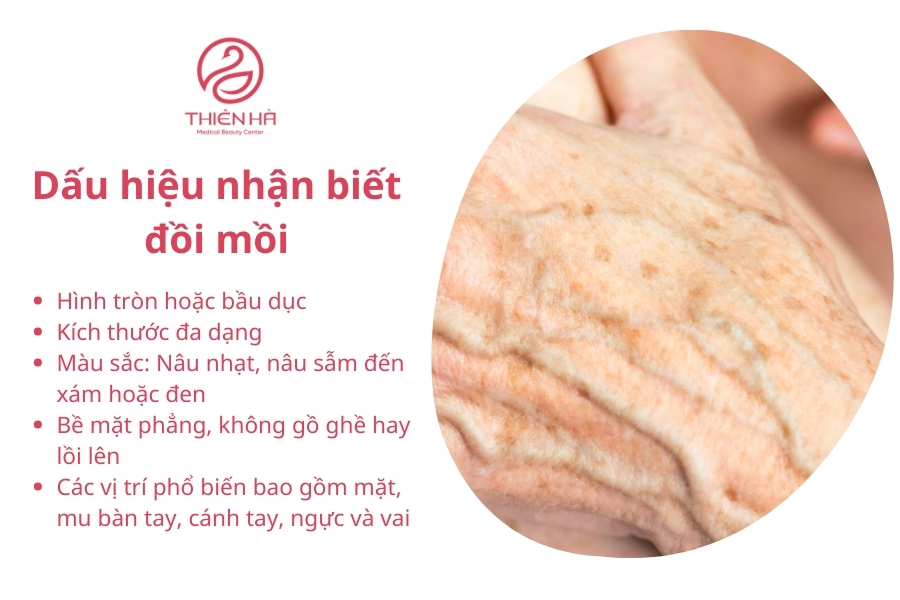 Nhận biết sớm các dấu hiệu của đồi mồi không chỉ giúp bạn tìm được cách điều trị phù hợp mà còn ngăn ngừa chúng lan rộng và gây mất thẩm mỹ. 