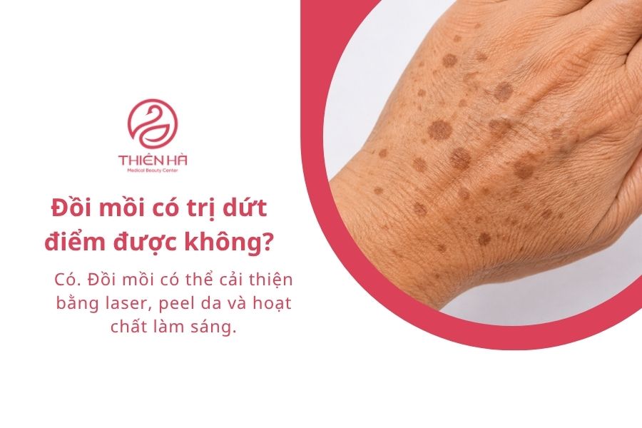 Đồi mồi là gì? Có nguy hiểm không và cách xử lý hiệu quả 10 Câu hỏi liên quan về đồi mồi trên da