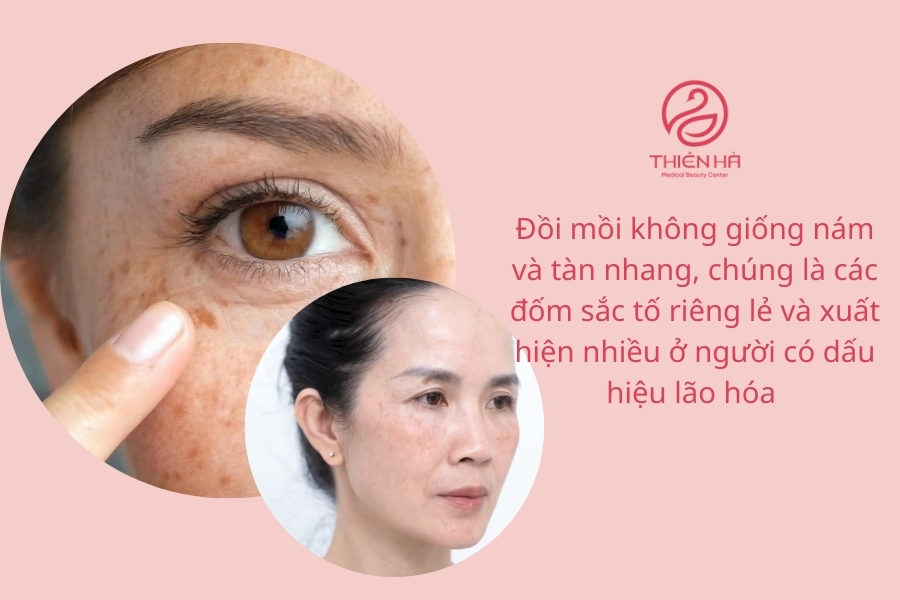 Việc phân biệt chính xác giữa đồi mồi và các vấn đề da khác không chỉ giúp bạn chọn đúng phương pháp điều trị mà còn đảm bảo an toàn, tránh bỏ qua những nguy cơ tiềm ẩn nghiêm trọng. 