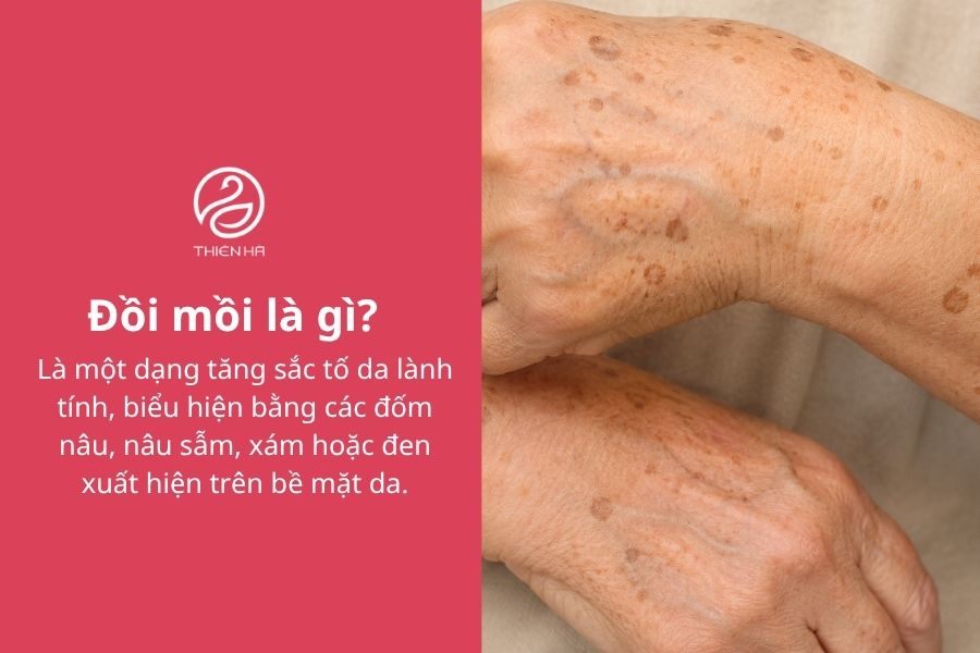 Đồi mồi là gì? Có nguy hiểm không và cách xử lý hiệu quả 1 Đồi mồi là gì?