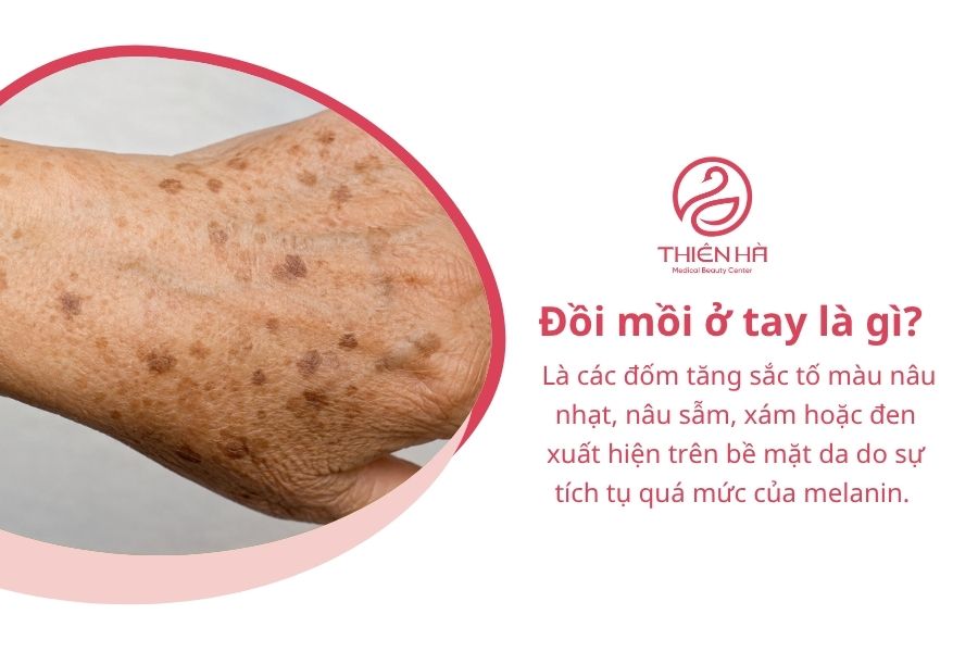 Đồi mồi ở tay: Nguyên nhân, có nguy hiểm không, cách trị 1 Đồi mồi ở tay là gì?