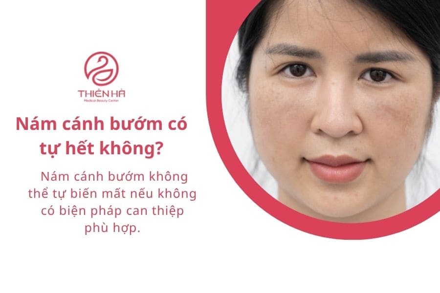 Câu hỏi thường gặp về nám cánh bướm 