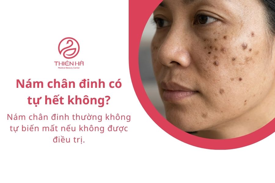 Câu hỏi thường gặp về nám chân đinh 