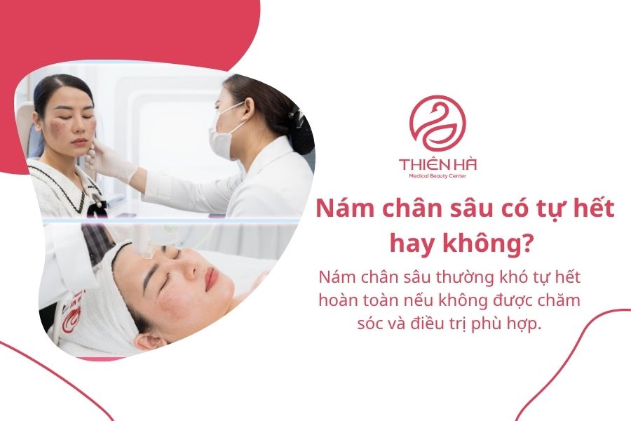 Nám chân sâu có tự hết hay không? 