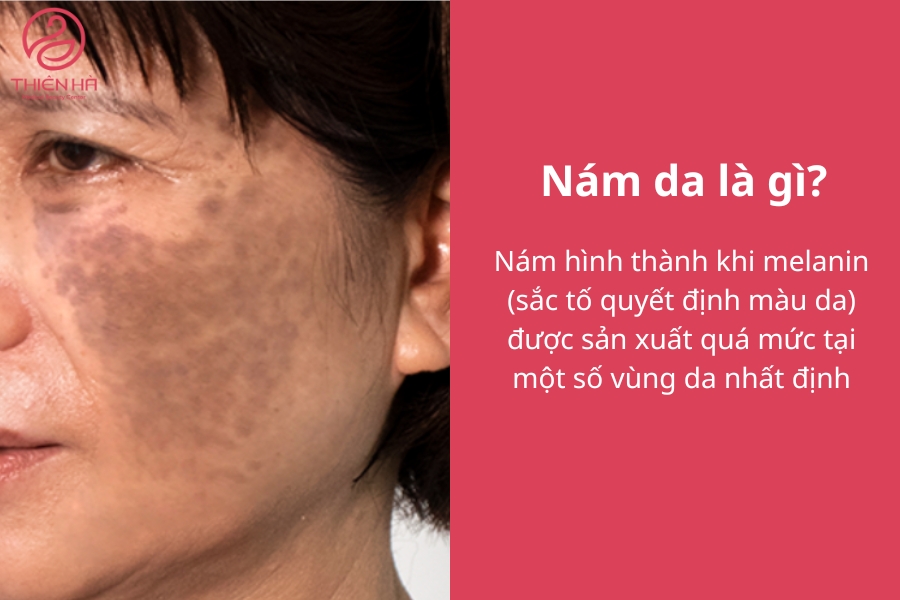 Gương mặt nám thường xuất hiện nhiều mảng tối màu trên da