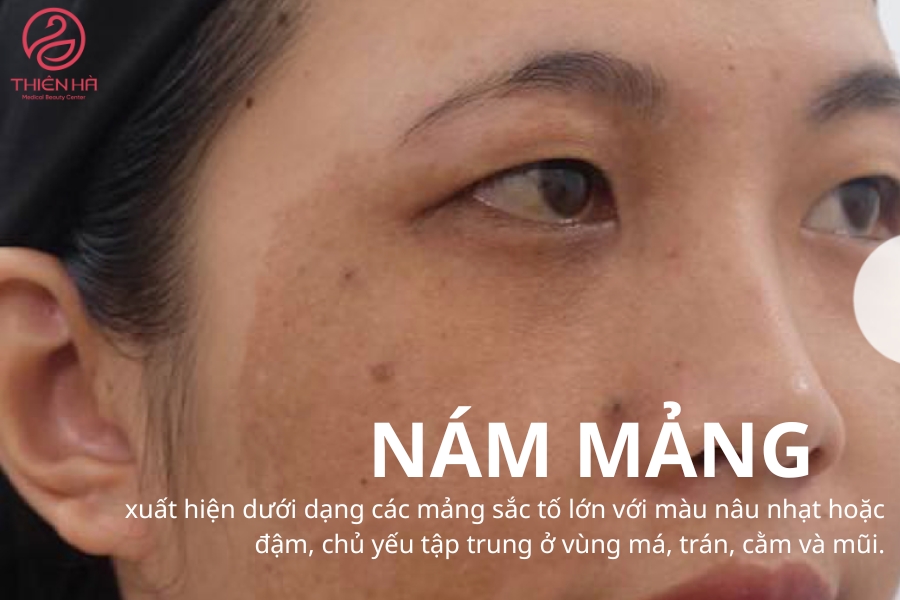 Hình ảnh nám da mặt thành từng mảng lớn