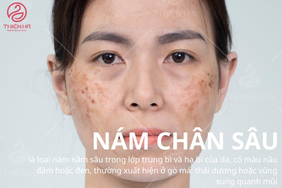 Da sạm nám chân sâu sẽ rất khó điều trị nếu không có sự kiên trì