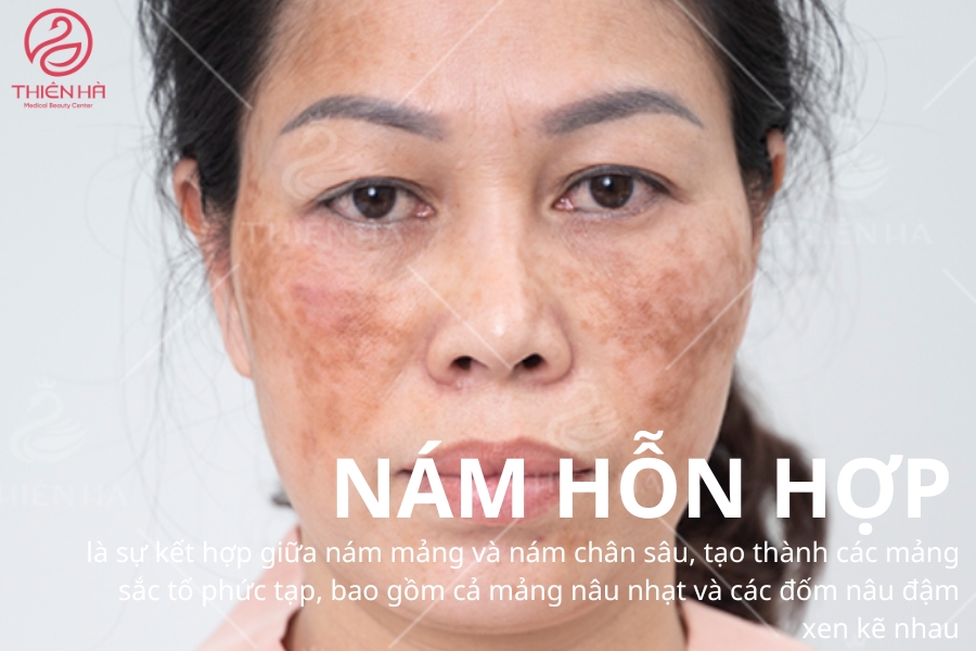 Nám hỗn hợp là loại nám khó điều trị nhất nhưng vẫn có thể khỏi nếu áp dụng đúng phương pháp