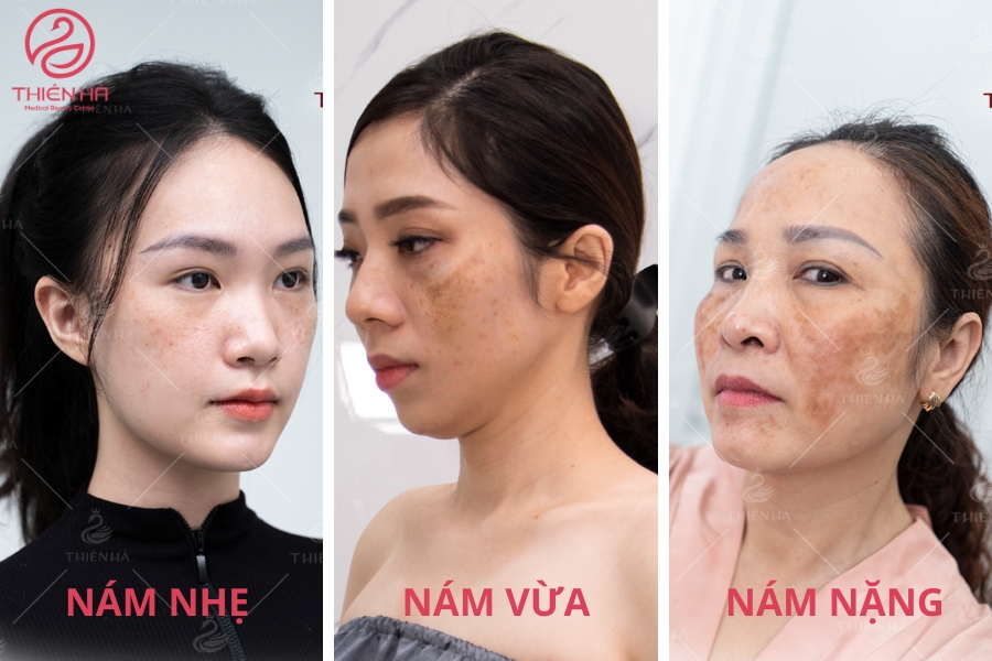 Hình ảnh nám da mặt ở từng giai đoạn khác nhau