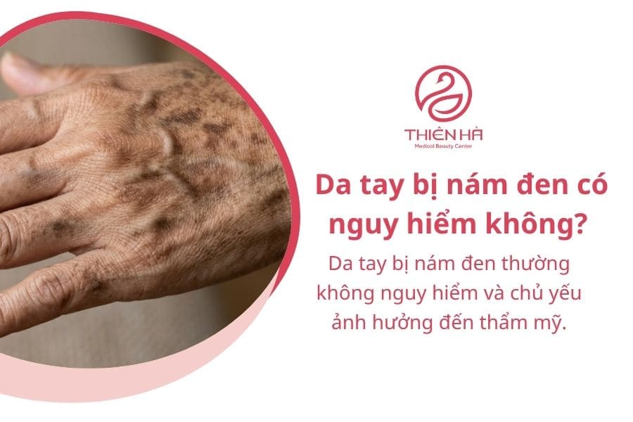 Nám da tay là gì? 
