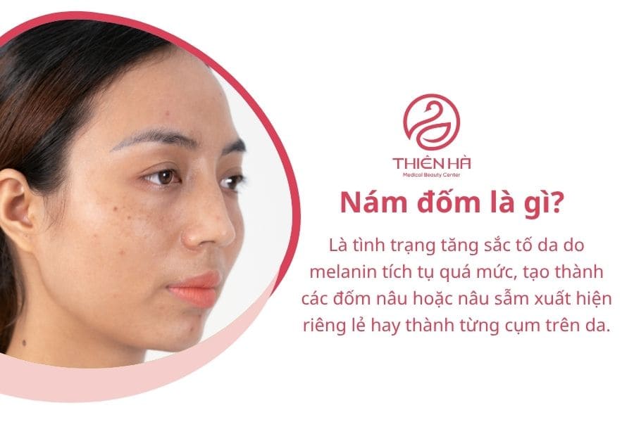 Nám đốm là gì? Nguyên nhân và cách điều trị nám đốm từ A-Z 1 Nám đốm là gì?
