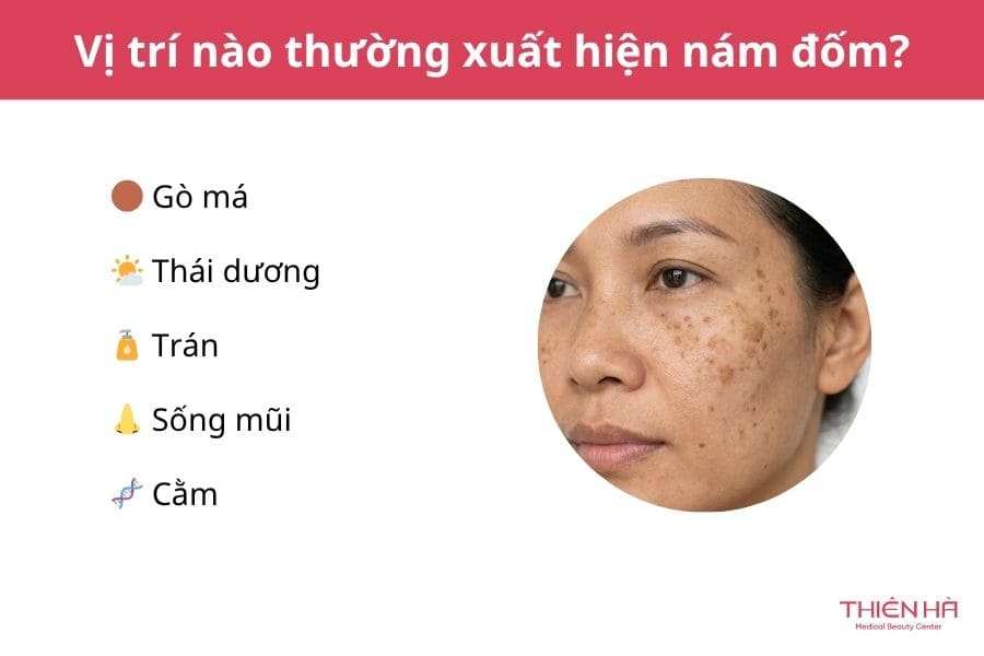 Nám đốm là gì? Nguyên nhân và cách điều trị nám đốm từ A-Z 2 Vị trí nào thường xuất hiện nám đốm