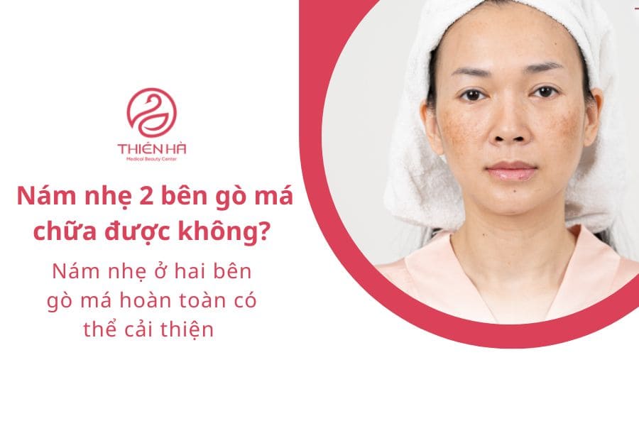 Nám nhẹ 2 bên gò má chữa được không? 
