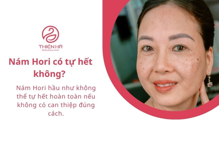 Nám Hori là gì? Giải pháp điều trị nám Hori an toàn, hiệu quả 5 Nám hori có tự hết hay không?