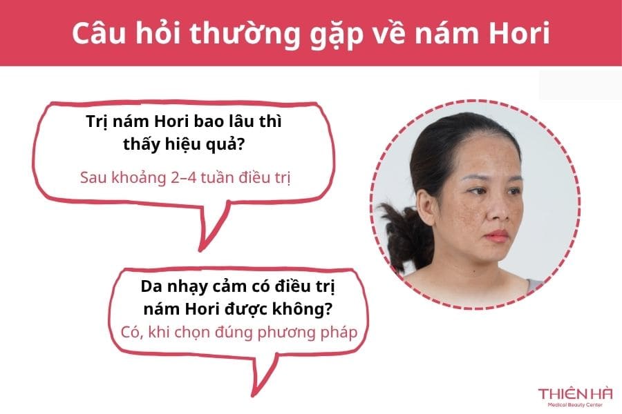Nám Hori là gì? Giải pháp điều trị nám Hori an toàn, hiệu quả 10 Câu hỏi thường gặp về nám Hori
