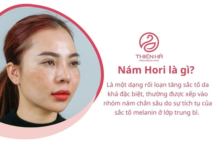 Nám Hori là gì? Giải pháp điều trị nám Hori an toàn, hiệu quả 1 Nám hori là gì?