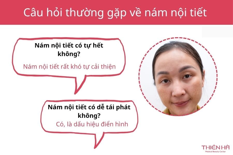 Nám nội tiết là gì? Dấu hiệu và cách điều trị hiệu quả 9 nam noi tiet 5 1