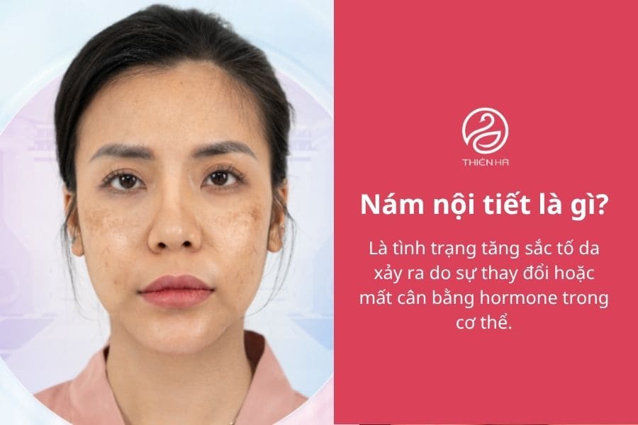 Nám nội tiết là gì? Dấu hiệu và cách điều trị hiệu quả 1 Nám nội tiết là gì?