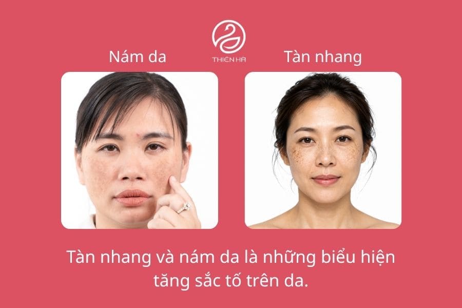 Phân biệt nám và tàn nhang: Điểm giống và khác nhau thế nào? 1 Tàn nhang, nám da là gì?