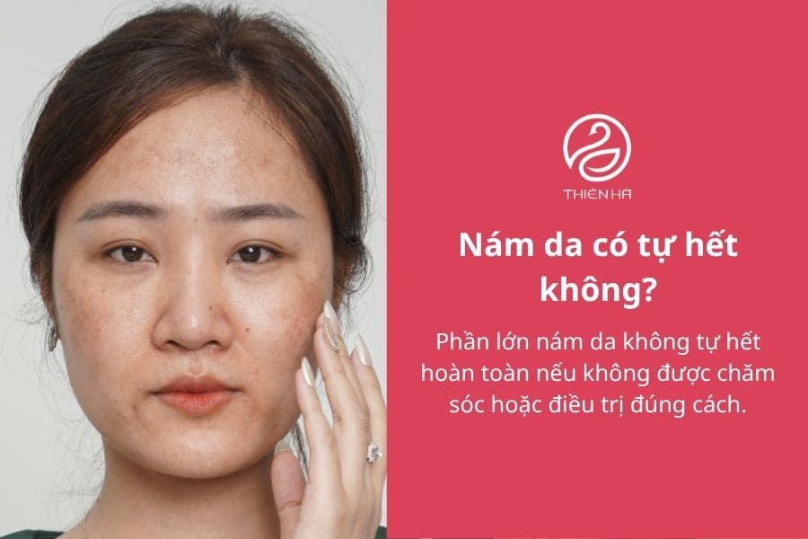 Phân biệt nám và tàn nhang: Điểm giống và khác nhau thế nào? 6 Các câu hỏi thường gặp về nám và tàn nhang