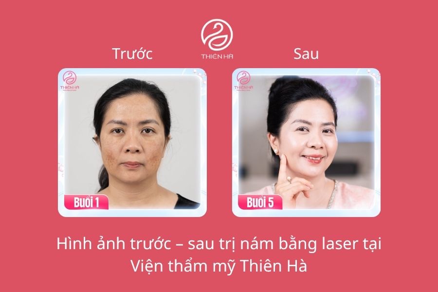 Hình ảnh trước – sau trị nám bằng laser tại Viện thẩm mỹ Thiên Hà