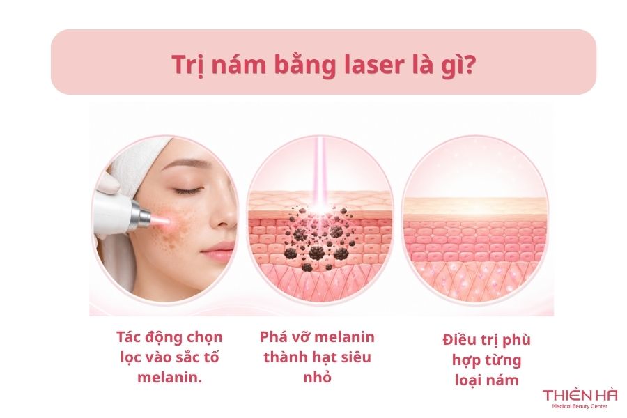 Trị nám bằng laser là gì?