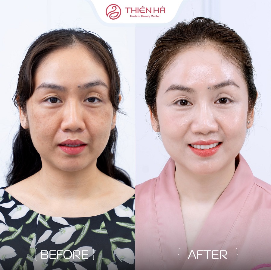 Hình ảnh thực tế khách hàng trị nàm bằng laser tại Viện thẩm mỹ Thiên Hà