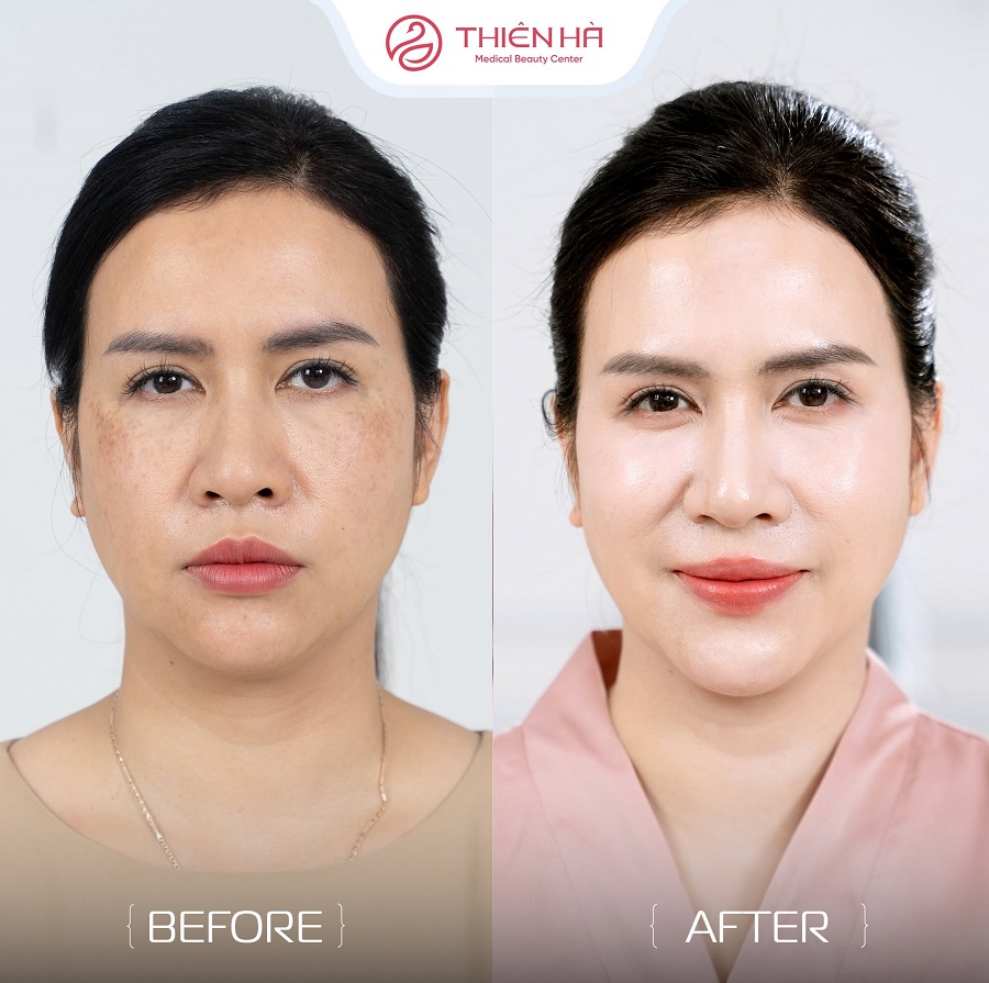 Hình ảnh khách hàng trước sau điều trị nám tại Viện thẩm mỹ Thiên Hà