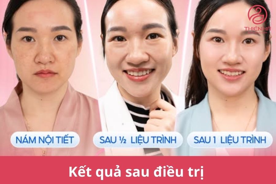 Kết quả sau điều trị