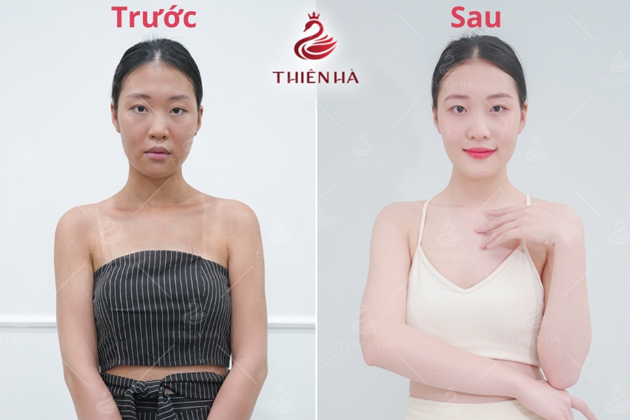 Tắm trắng: Tất tần tật những điều bạn cần biết 7 Hình ảnh khách hàng trước và sau khi tắm trắng tại Thiên Hà