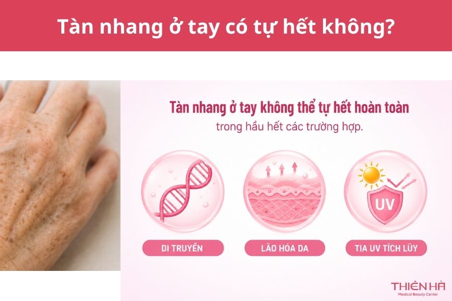 Tàn nhang ở tay có tự hết không?