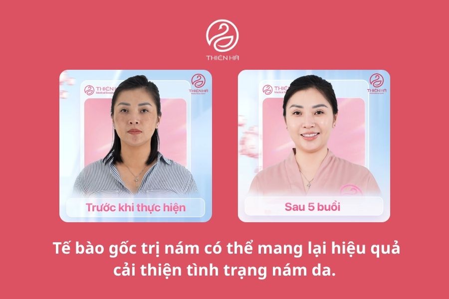 Tế bào gốc trị nám là gì? Hiệu quả và chi phí thực tế 3 Tế bào gốc trị nám có hiệu quả không?