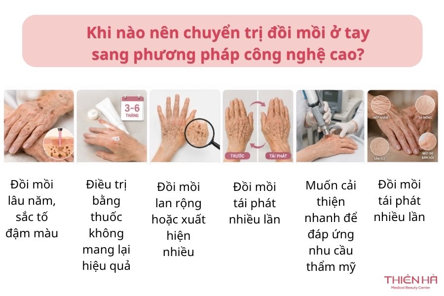 Khi nào nên chuyển sang trị đồi mồi ở tay bằng  phương pháp công nghệ cao?