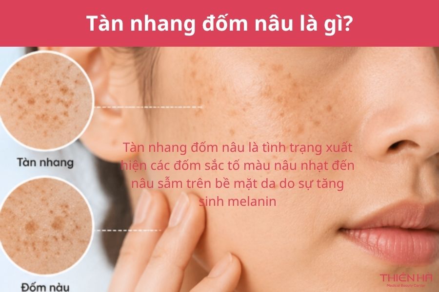 Tàn nhang đốm nâu là gì? 