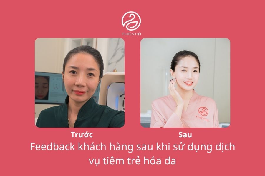 Tiêm trẻ hoá da: 5 công nghệ uy tín, căng bóng nhất 8 Hình ảnh thực tế trước và sau khi tiêm trẻ hóa da của diễn viên Minh Khuê tại Thẩm mỹ viện Thiên Hà