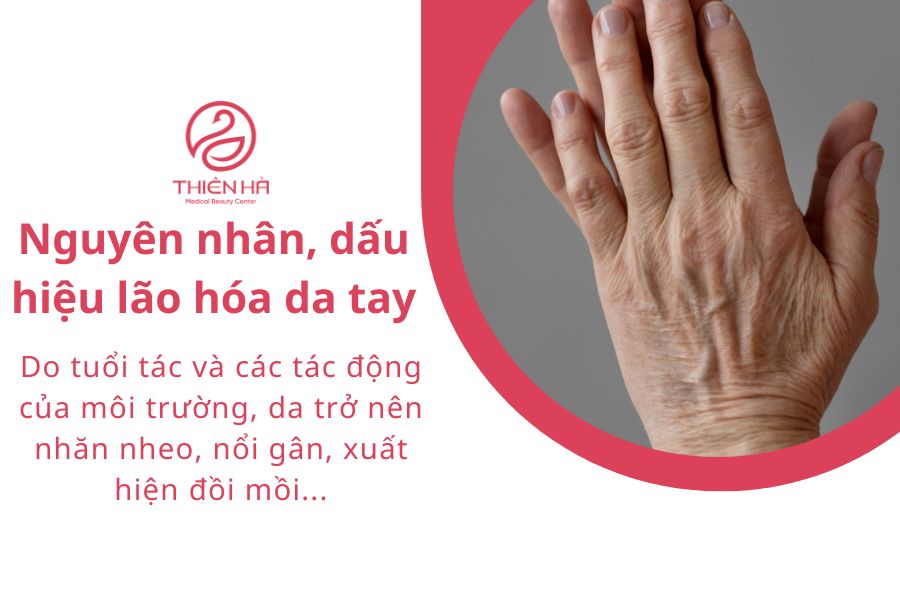 Trẻ hóa bàn tay: 5 công nghệ xóa nhăn, gân xanh hiệu quả nhất 1 Da tay là nơi nhận thấy những dấu hiệu lão hóa sớm bởi cấu trúc da mỏng, ít mô mỡ và chịu nhiều tác động môi trường