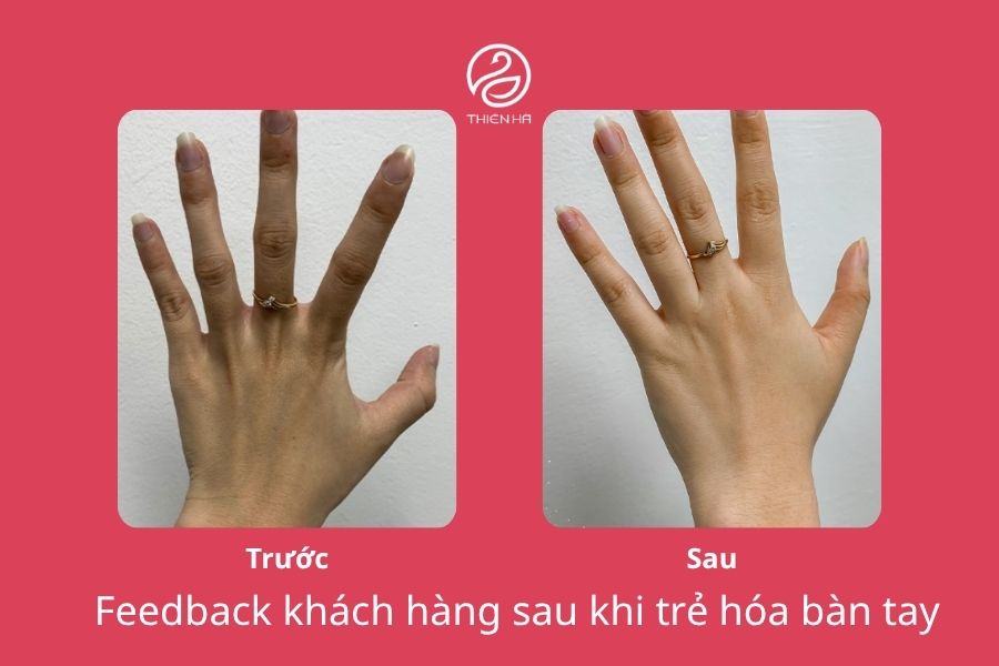 Trẻ hóa bàn tay: 5 công nghệ xóa nhăn, gân xanh hiệu quả nhất 5 Bàn tay gầy guộc, trơ xương trở thành tay búp măng đầy đặn chỉ sau 60 phút trẻ hóa bàn tay tại Thẩm mỹ viện Thiên Hà
