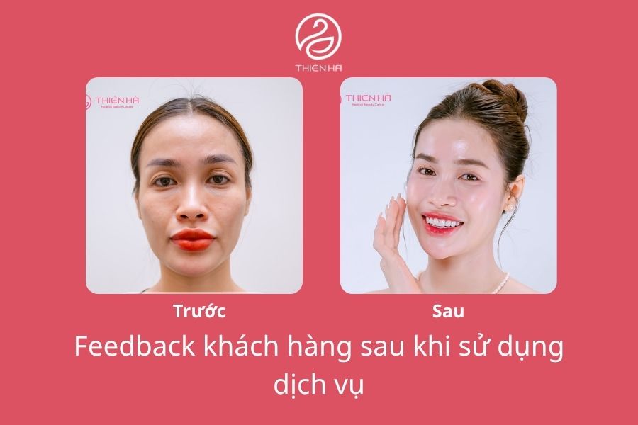 Trẻ hóa da là gì? 10+ phương pháp trẻ hóa da mặt hiệu quả nhất 9 Chị Phương Anh Đào sau liệu trình trẻ hóa da 3 tháng bằng trẻ hóa nguyên bào SMAS Point tại Thẩm mỹ viện Thiên Hà