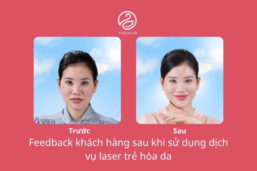 Trẻ Hóa Da Bằng Laser Có Tốt Không? Review Hiệu Quả 2 Hình ảnh da trước khi thực hiện có nhiều nám, lỗ chân lông to, sẹo mụn và sau khi thực hiện laser trẻ hóa da sáng mịn, đều màu của khách hàng tại Thẩm mỹ viện Thiên Hà