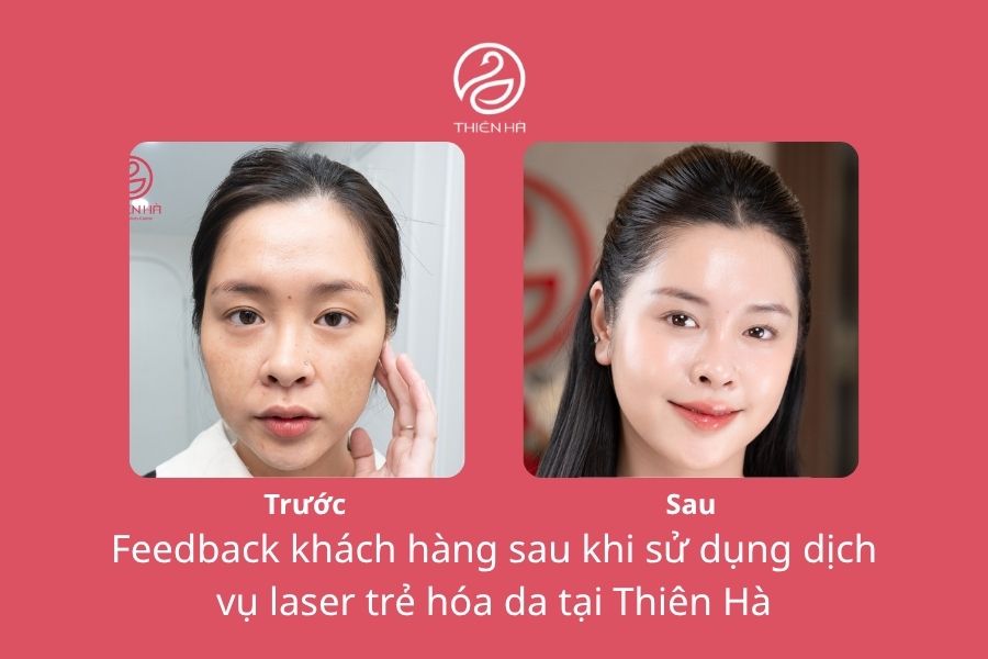 Trẻ Hóa Da Bằng Laser Có Tốt Không? Review Hiệu Quả 6 Hình ảnh da thật của khách hàng trước và sau khi thực hiện laser trẻ hóa da tại Thẩm mỹ viện Thiên Hà